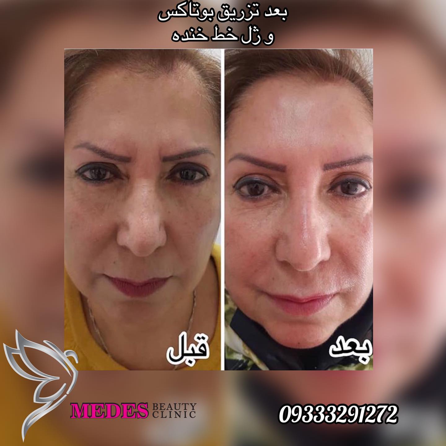 گالری تزریق بوتاکس